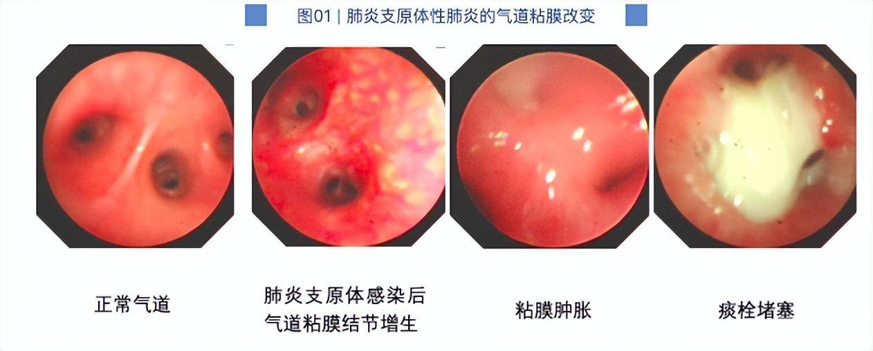 7岁男童肺部实变！有医院一天最高峰67例“洗肺”……