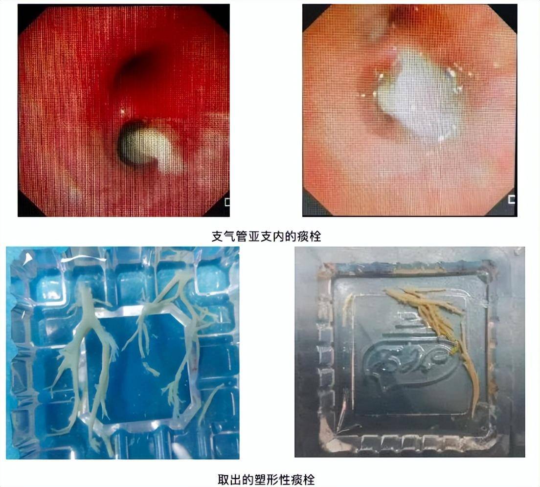 7岁男童肺部实变！有医院一天最高峰67例“洗肺”……