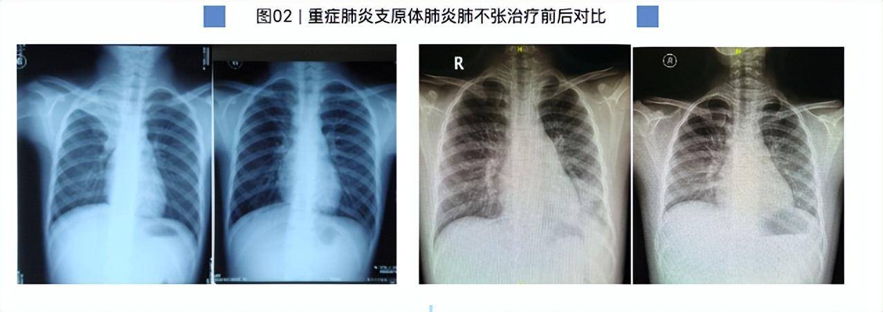 7岁男童肺部实变！有医院一天最高峰67例“洗肺”……